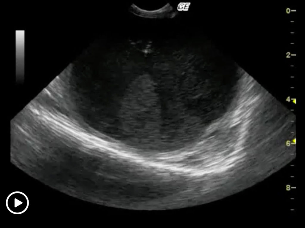 Ultrasound-Guided Drainage - SonoPath