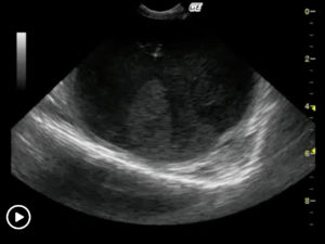 Ultrasound-Guided Drainage