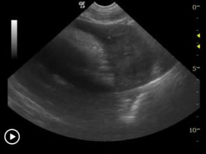 Ultrasound-Guided Pericardiocentesis