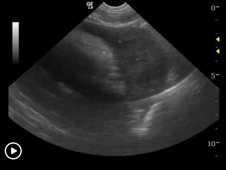 Ultrasound-Guided Pericardiocentesis - SonoPath