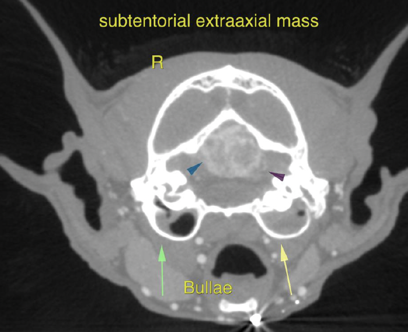 Large Subtentorial Extraaxial Intracranial Mass: our Case of the Month ...