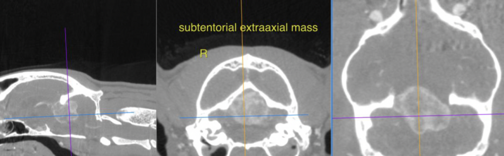 Large Subtentorial Extraaxial Intracranial Mass: our Case of the Month ...